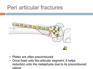 Peri articular fractures
• Plates are often precontoured
• Once fixed unto the articular segment, it helps
reduction unto the metaphysis due to its precontoured
nature
 