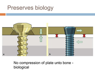 Preserves biology
No compression of plate unto bone -
biological
 