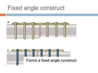 Fixed angle construct
Forms a fixed angle construct
 