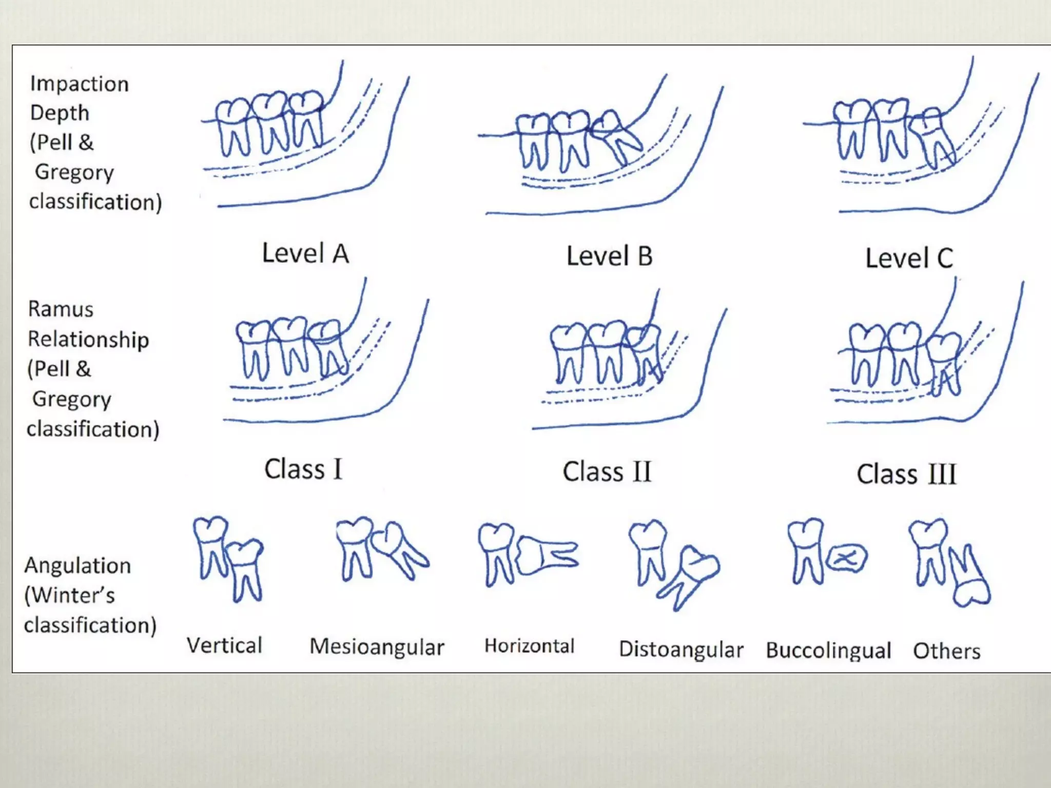 Principles of Management of Impacted Teeth Part I | PDF