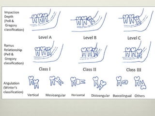 Principles of Management of Impacted Teeth Part I | PDF