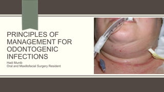 PRINCIPLES OF
MANAGEMENT FOR
ODONTOGENIC
INFECTIONS
Hadi Munib
Oral and Maxillofacial Surgery Resident
 