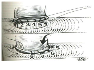 Microsurgery Sign Principles of Microsurgery | PPTX