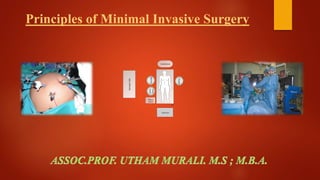 Principles of Minimal Invasive Surgery
Anesthesia
InstrumentTable
AssistantScrub
Nurse
Monitor
Mayo
Stand
Surgeon
 