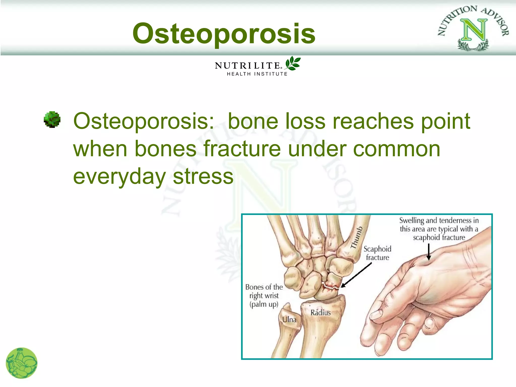 Osteoporosis

Osteoporosis: bone loss reaches point
when bones fracture under common
everyday stress
 