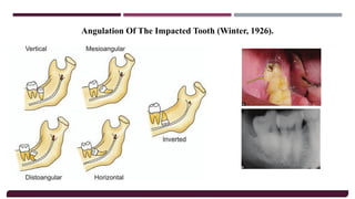 Principles Of Oral Surgery, Armamentarium &.pptx