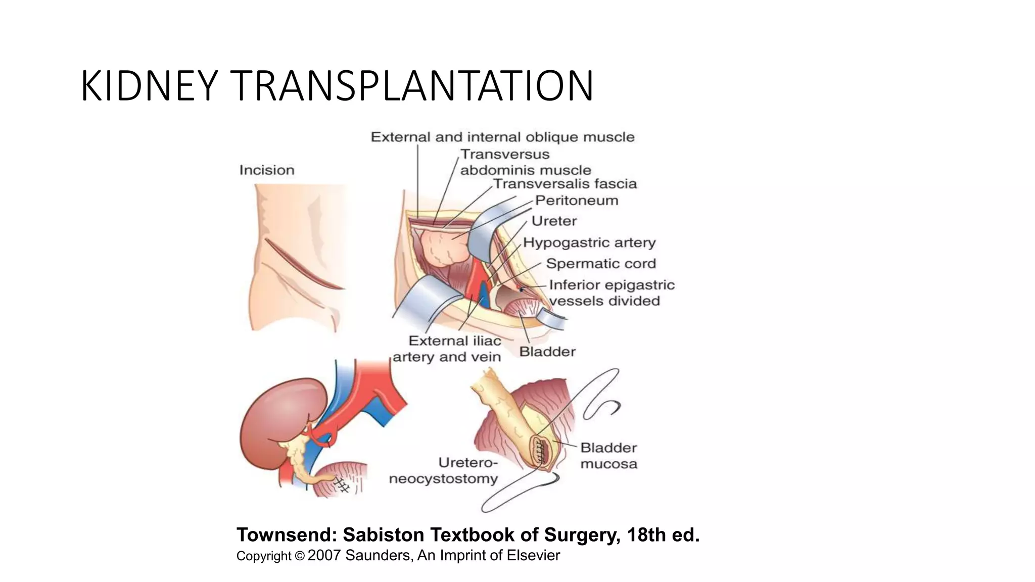 KIDNEY TRANSPLANTATION
Townsend: Sabiston Textbook of Surgery, 18th ed.
Copyright © 2007 Saunders, An Imprint of Elsevier
 