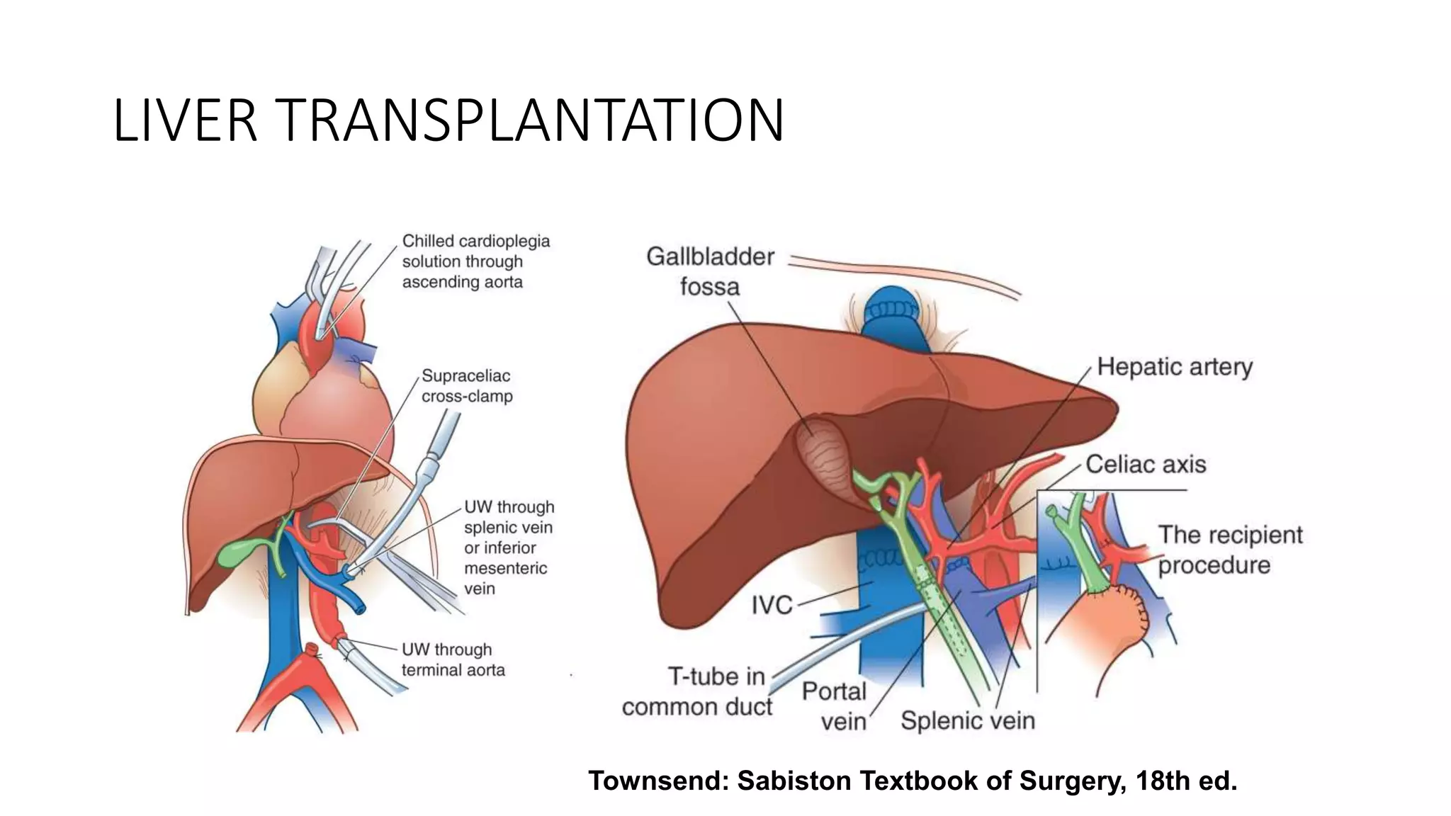 LIVER TRANSPLANTATION
Townsend: Sabiston Textbook of Surgery, 18th ed.
 