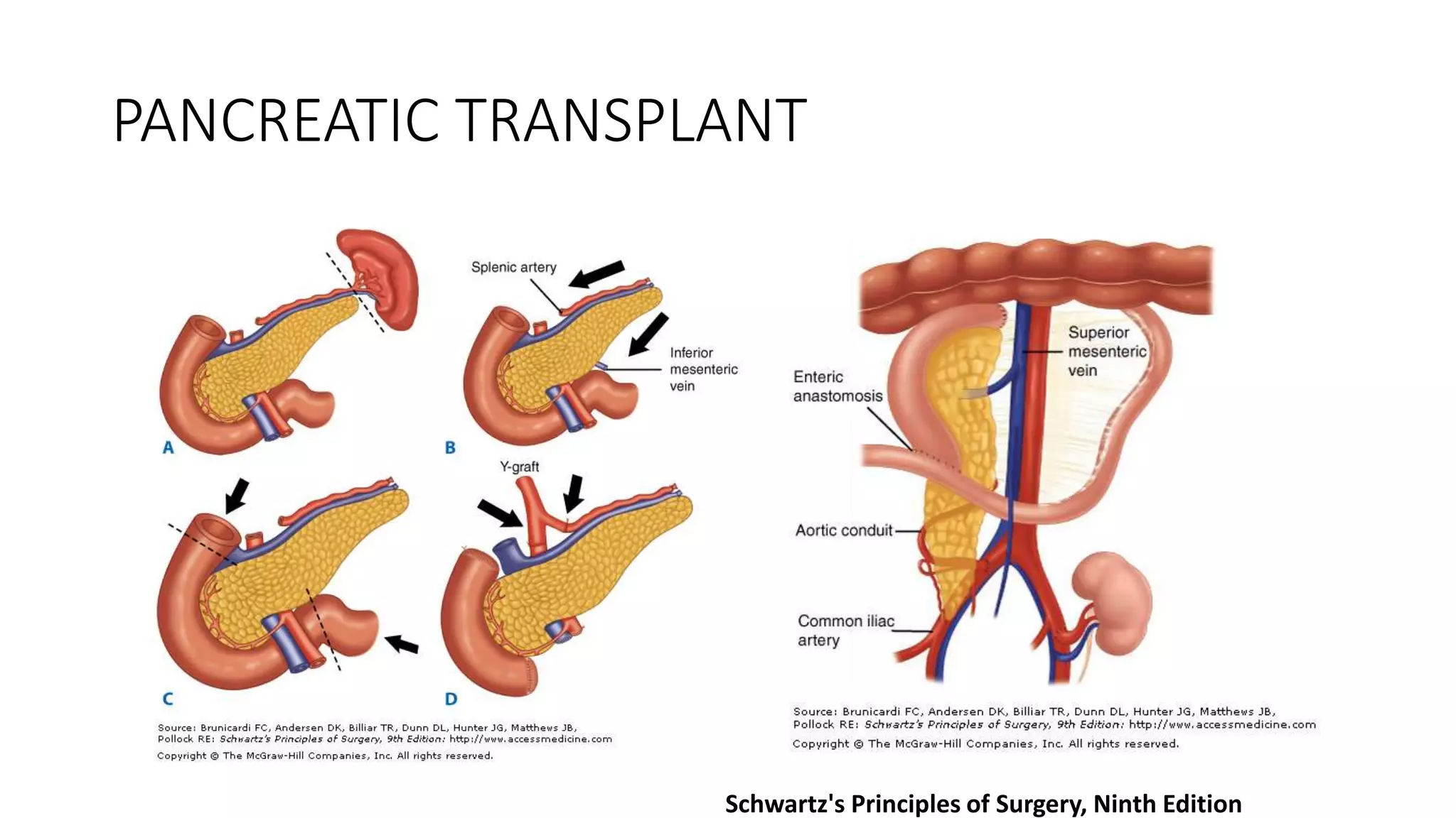 PANCREATIC TRANSPLANT
Schwartz's Principles of Surgery, Ninth Edition
 