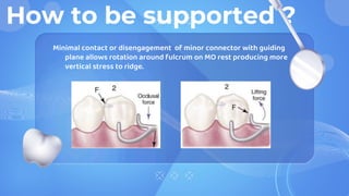 How to be supported ?
Minimal contact or disengagement of minor connector with guiding
plane allows rotation around fulcrum on MO rest producing more
vertical stress to ridge.
 