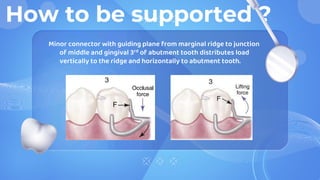How to be supported ?
Minor connector with guiding plane from marginal ridge to junction
of middle and gingival 3rd of abutment tooth distributes load
vertically to the ridge and horizontally to abutment tooth.
 
