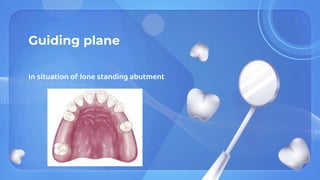 Guiding plane
In situation of lone standing abutment
 