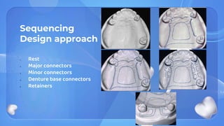 Sequencing
Design approach
1. Rest
2. Major connectors
3. Minor connectors
4. Denture base connectors
5. Retainers
 