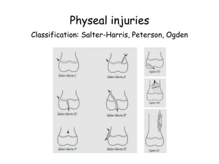 Physeal injuries
Classification: Salter-Harris, Peterson, Ogden
 