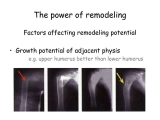The power of remodeling
Factors affecting remodeling potential
• Growth potential of adjacent physis
e.g. upper humerus better than lower humerus
 
