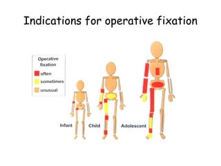 Indications for operative fixation
 