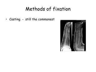 Methods of fixation
• Casting - still the commonest
 