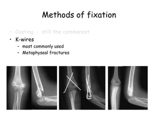 Methods of fixation
• Casting - still the commonest
• K-wires
– most commonly used
– Metaphyseal fractures
 