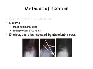 Methods of fixation
• Casting - still the commonest
• K-wires
– most commonly used
– Metaphyseal fractures
• K- wires could be replaced by absorbable rods
 