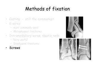 Methods of fixation
• Casting - still the commonest
• K-wires
– most commonly used
– Metaphyseal fractures
• Intramedullary wires, elastic nails
– Very useful
– Diaphyseal fractures
• Screws
 
