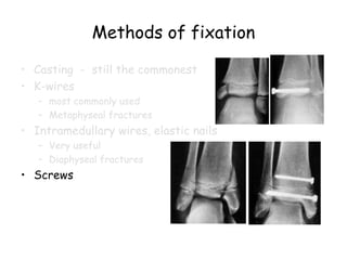 Methods of fixation
• Casting - still the commonest
• K-wires
– most commonly used
– Metaphyseal fractures
• Intramedullary wires, elastic nails
– Very useful
– Diaphyseal fractures
• Screws
 