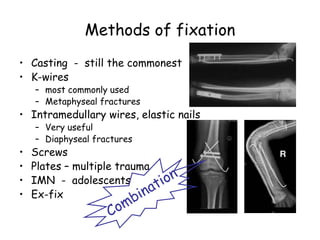 Methods of fixation
• Casting - still the commonest
• K-wires
– most commonly used
– Metaphyseal fractures
• Intramedullary wires, elastic nails
– Very useful
– Diaphyseal fractures
• Screws
• Plates – multiple trauma
• IMN - adolescents
• Ex-fix
 