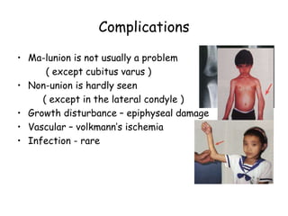 Complications
• Ma-lunion is not usually a problem
( except cubitus varus )
• Non-union is hardly seen
( except in the lateral condyle )
• Growth disturbance – epiphyseal damage
• Vascular – volkmann’s ischemia
• Infection - rare
 