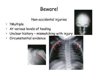 Beware!
Non-accidental injuries
• ?Multiple
• At various levels of healing
• Unclear history – mismatching with injury
• Circumstantial evidence
 