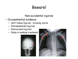 Beware!
Non-accidental injuries
• Circumstantial evidence
• Soft tissue injuries - bruising, burns
• Intraabdominal injuries
• Intracranial injuries
• Delay in seeking treatment
 