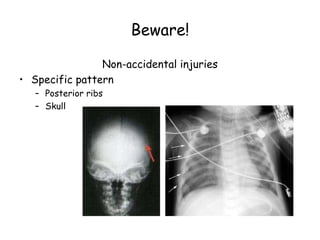 Beware!
Non-accidental injuries
• Specific pattern
– Posterior ribs
– Skull
 
