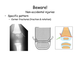 Beware!
Non-accidental injuries
• Specific pattern
– Corner fractures (traction & rotation)
 