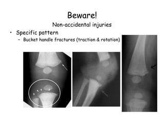 Beware!
Non-accidental injuries
• Specific pattern
– Bucket handle fractures (traction & rotation)
 