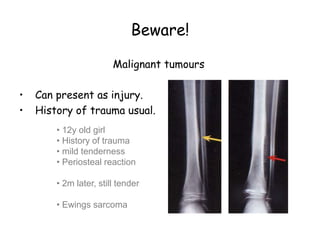 Beware!
Malignant tumours
• Can present as injury.
• History of trauma usual.
• 12y old girl
• History of trauma
• mild tenderness
• Periosteal reaction
• 2m later, still tender
• Ewings sarcoma
 