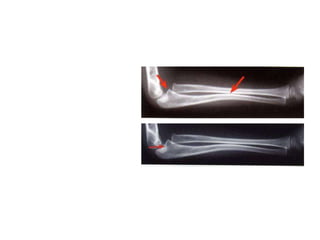 Principles_of_Pediatric_Fractures.ppt