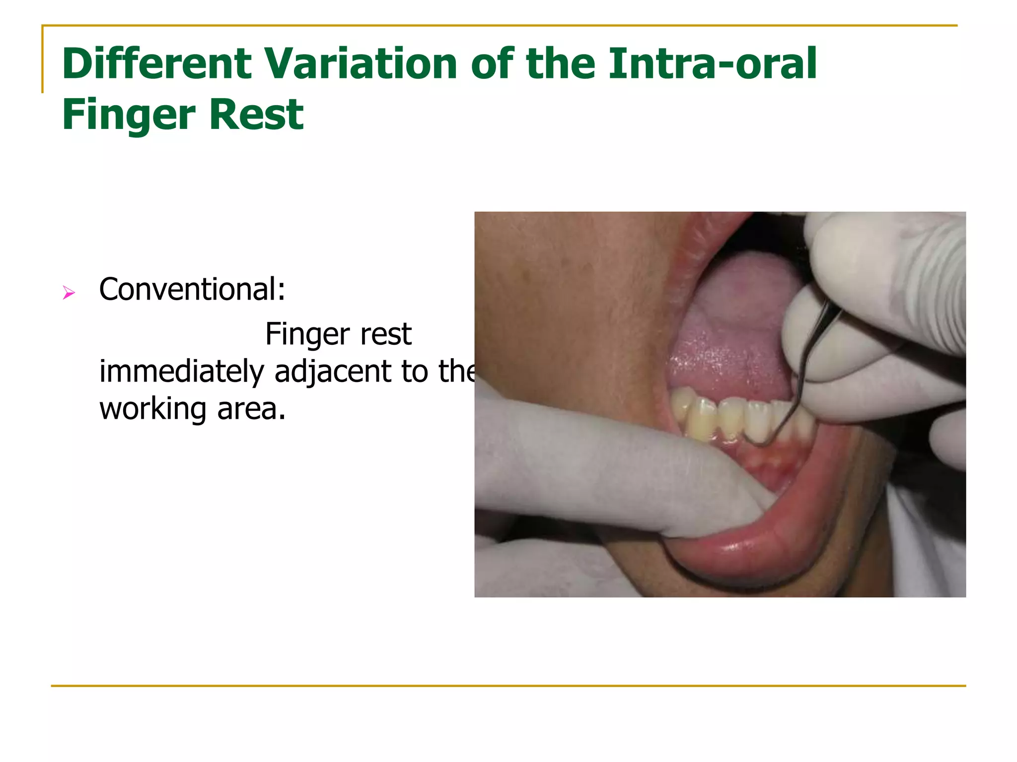 Point Finger Rest Principles of periodontal instrumentation | PPT