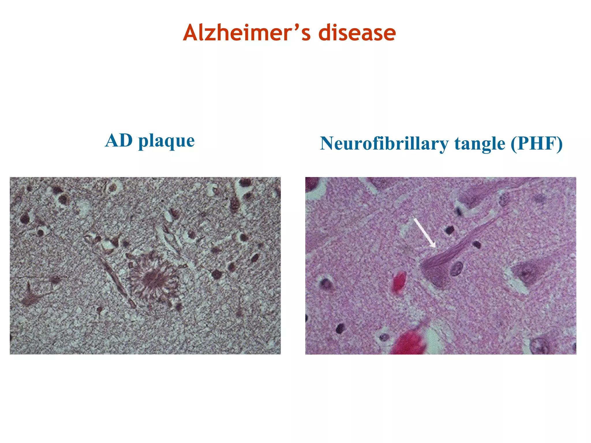 AD plaque Neurofibrillary tangle (PHF)
Alzheimer’s disease
 