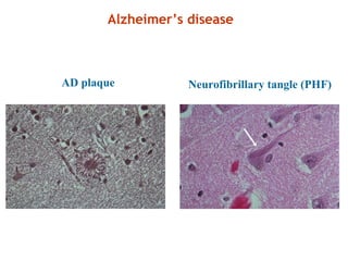 AD plaque Neurofibrillary tangle (PHF)
Alzheimer’s disease
 