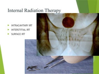 Radiation Intersititial Principles of Radiation therapy2_022756.pptx