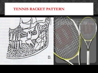 Doouble Racket Pattern Principles of radiographic interpretation | PPTX