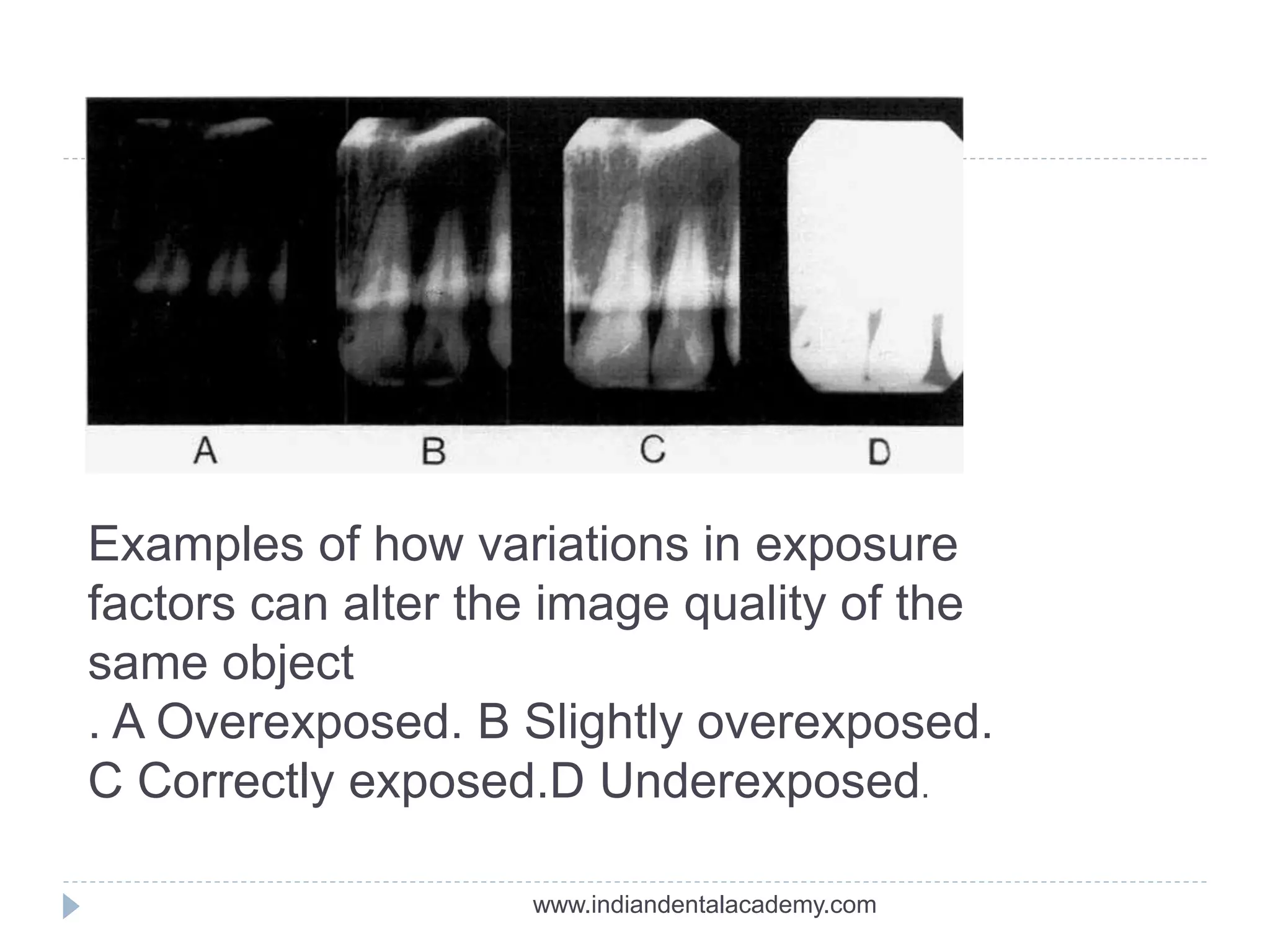Examples of how variations in exposure
factors can alter the image quality of the
same object
. A Overexposed. B Slightly overexposed.
C Correctly exposed.D Underexposed.
www.indiandentalacademy.com
 