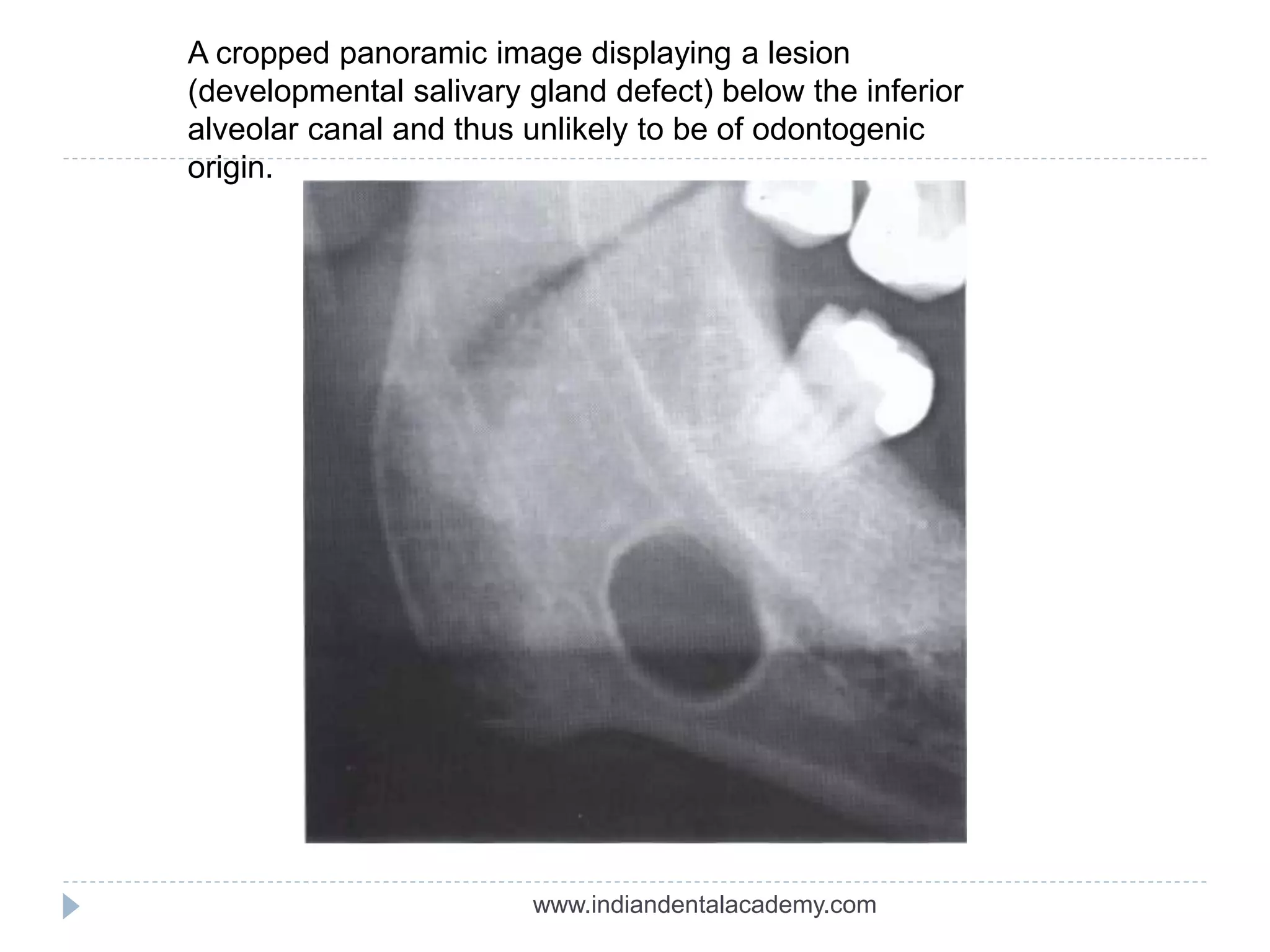 A cropped panoramic image displaying a lesion
(developmental salivary gland defect) below the inferior
alveolar canal and thus unlikely to be of odontogenic
origin.
www.indiandentalacademy.com
 