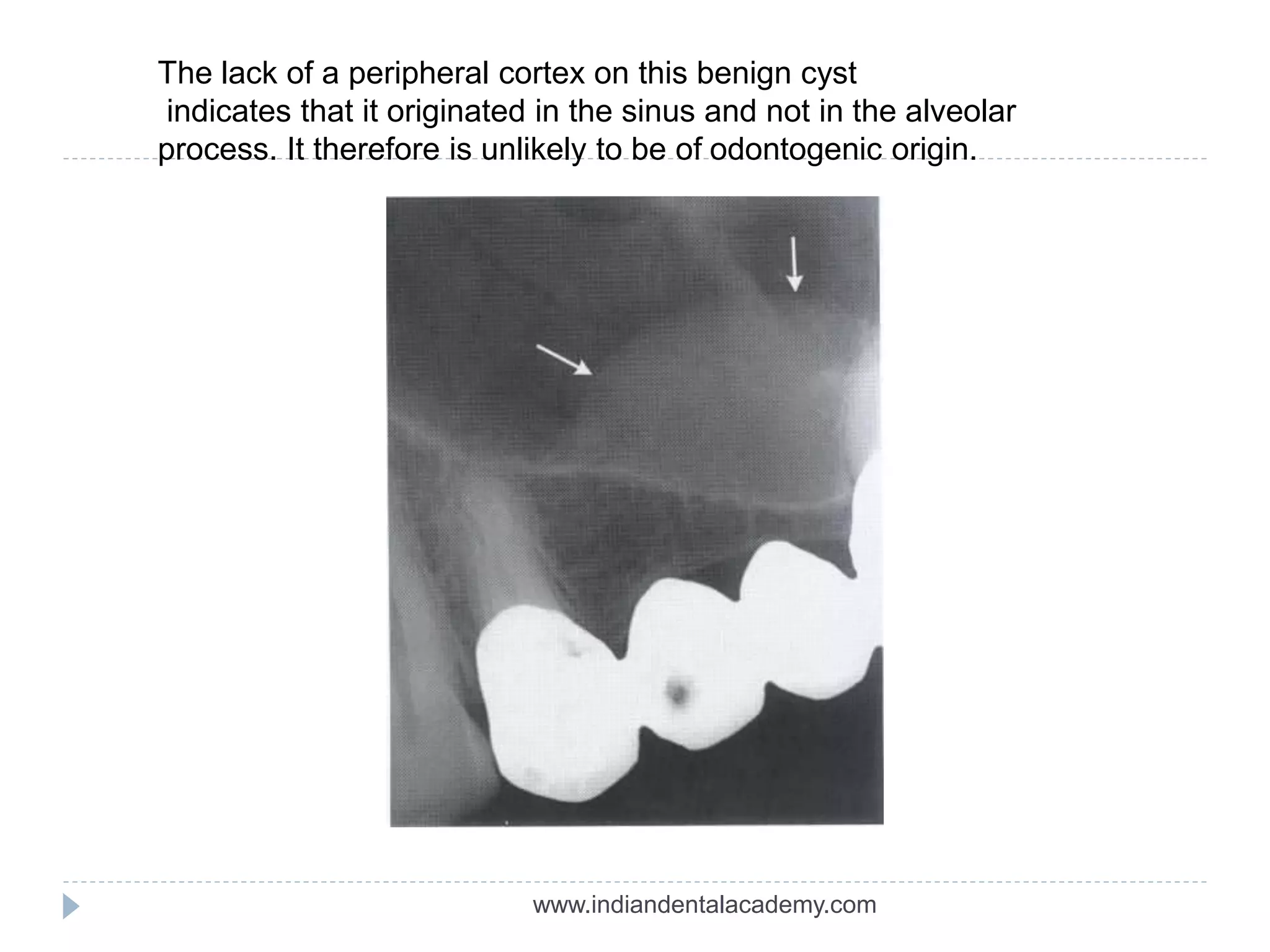 The lack of a peripheral cortex on this benign cyst
indicates that it originated in the sinus and not in the alveolar
process. It therefore is unlikely to be of odontogenic origin.
www.indiandentalacademy.com
 