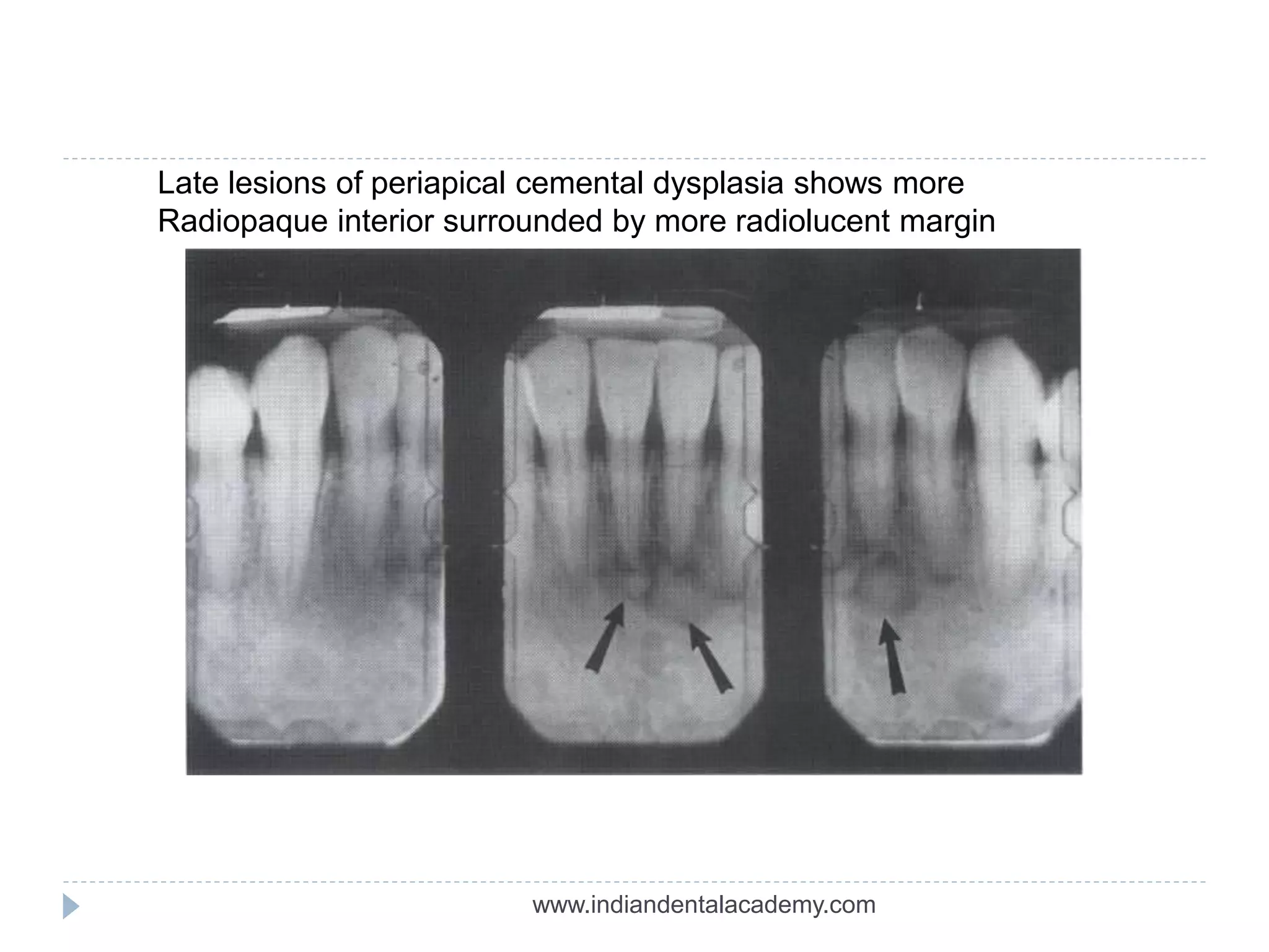 Late lesions of periapical cemental dysplasia shows more
Radiopaque interior surrounded by more radiolucent margin
www.indiandentalacademy.com
 
