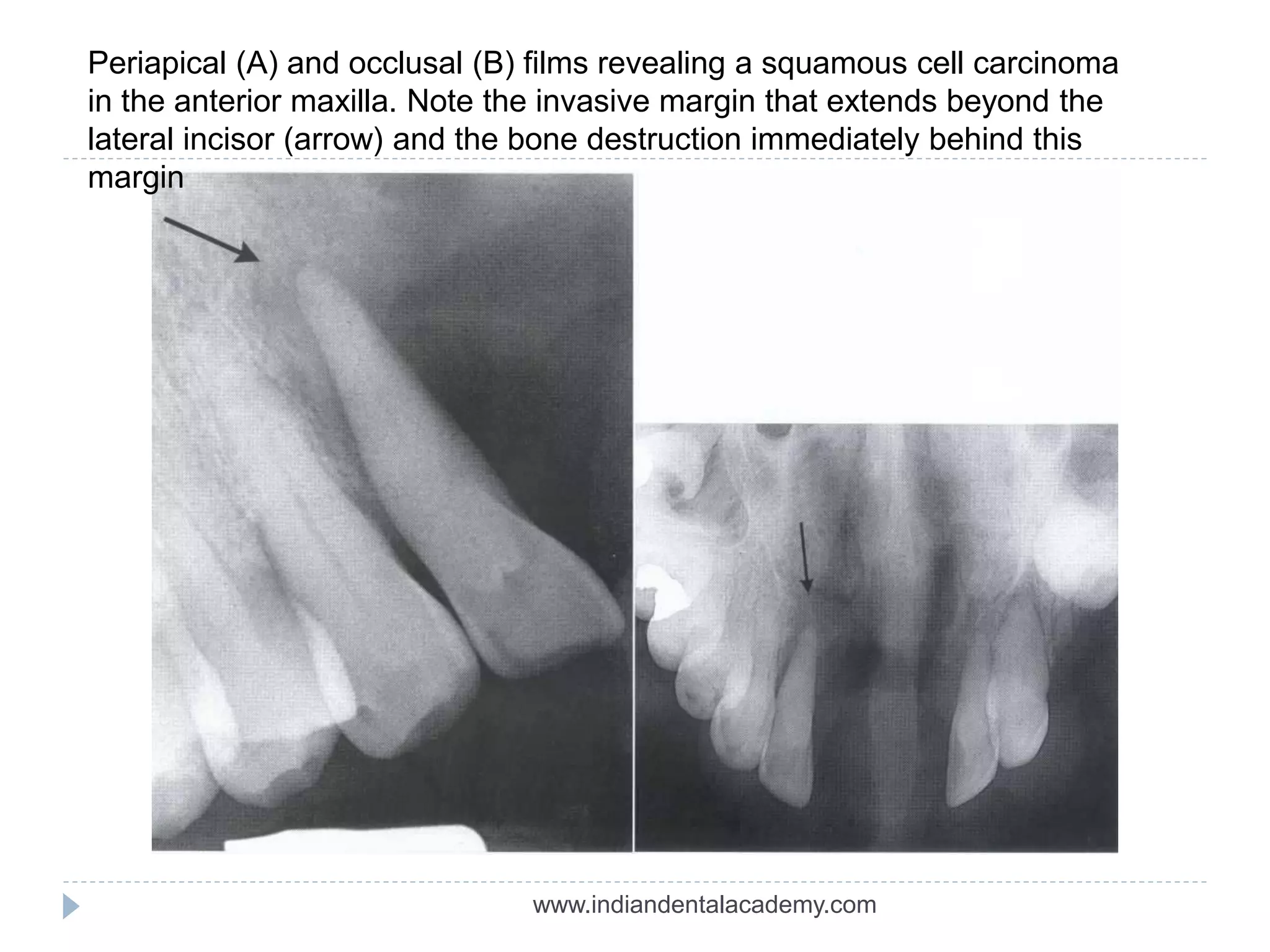 Periapical (A) and occlusal (B) films revealing a squamous cell carcinoma
in the anterior maxilla. Note the invasive margin that extends beyond the
lateral incisor (arrow) and the bone destruction immediately behind this
margin
www.indiandentalacademy.com
 