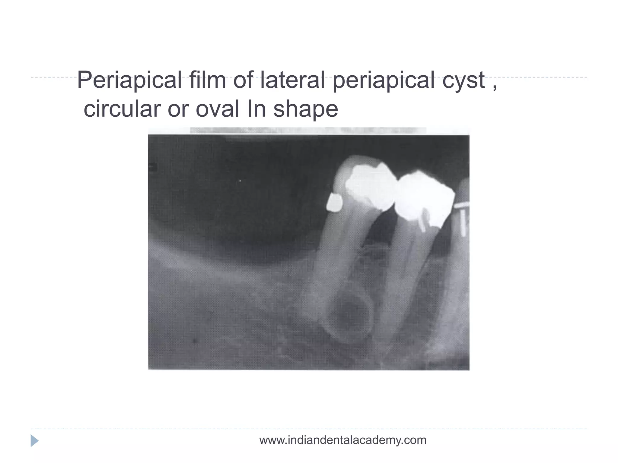 Periapical film of lateral periapical cyst ,
circular or oval In shape
www.indiandentalacademy.com
 