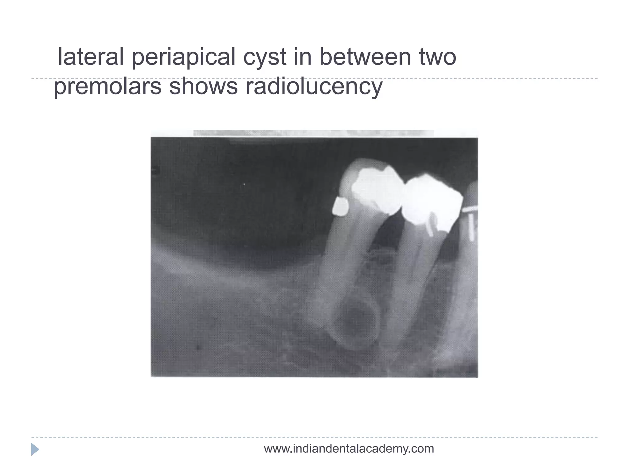lateral periapical cyst in between two
premolars shows radiolucency
www.indiandentalacademy.com
 