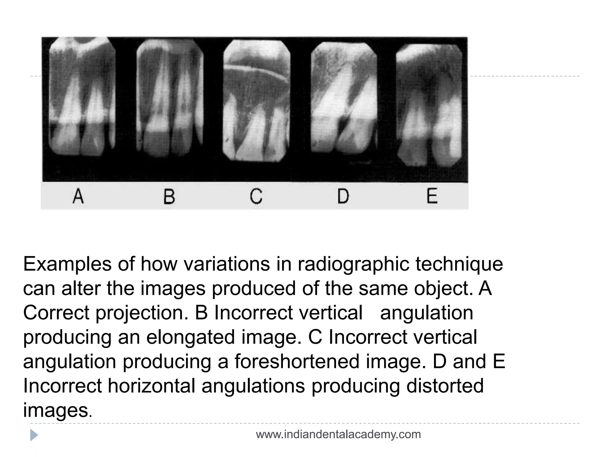 Examples of how variations in radiographic technique
can alter the images produced of the same object. A
Correct projection. B Incorrect vertical angulation
producing an elongated image. C Incorrect vertical
angulation producing a foreshortened image. D and E
Incorrect horizontal angulations producing distorted
images.
www.indiandentalacademy.com
 