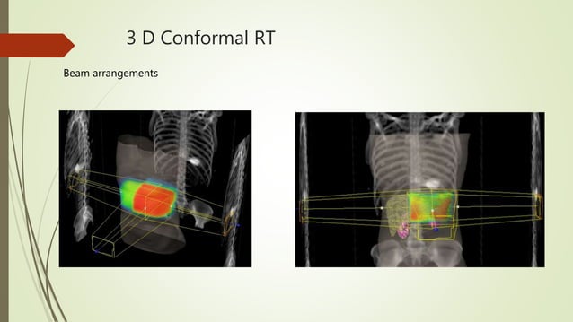 Reflecting Block Radiotherapy Principles of radiotherapy in gastric carcinoma | PPTX