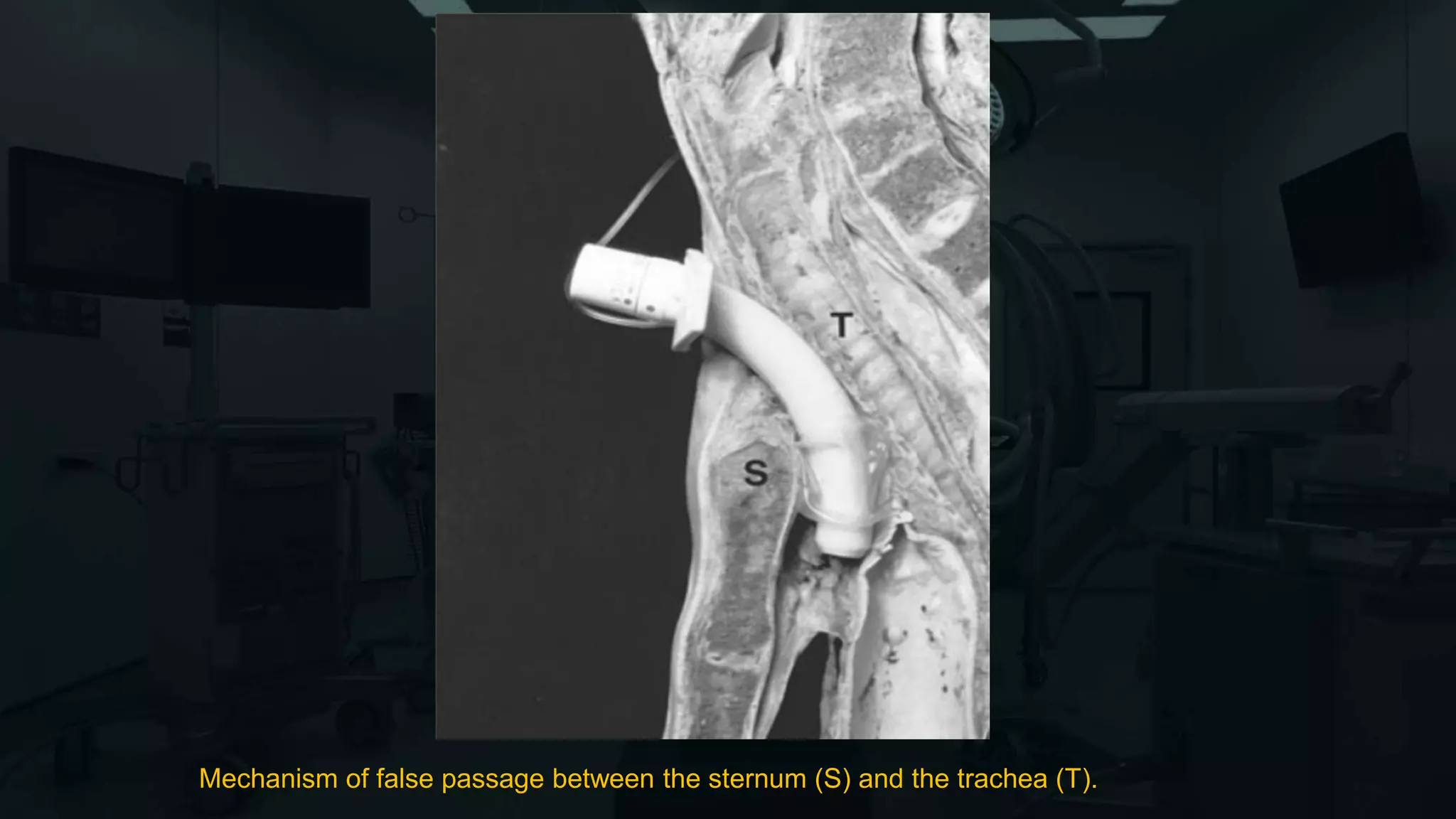 Mechanism of false passage between the sternum (S) and the trachea (T).
 