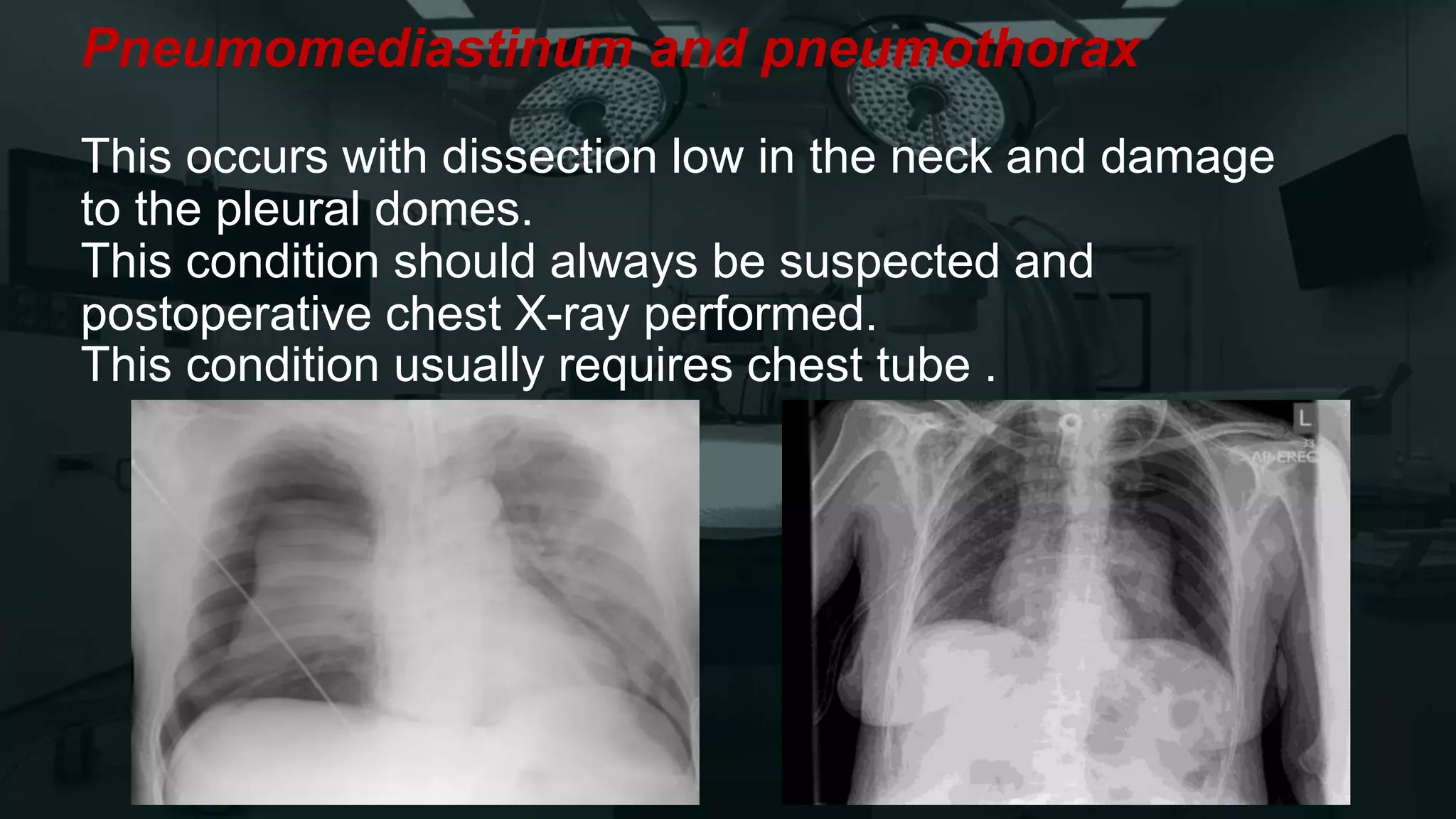 Pneumomediastinum and pneumothorax
This occurs with dissection low in the neck and damage
to the pleural domes.
This condition should always be suspected and
postoperative chest X-ray performed.
This condition usually requires chest tube .
 